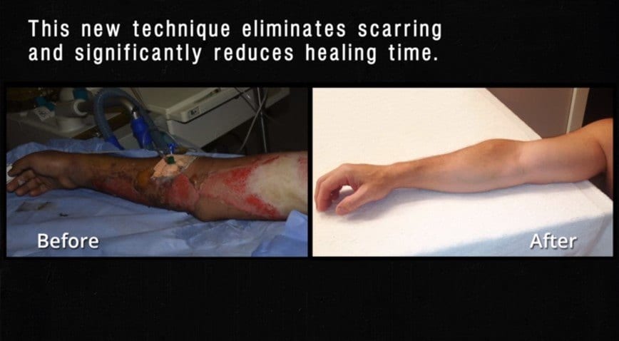 new technique healing gun