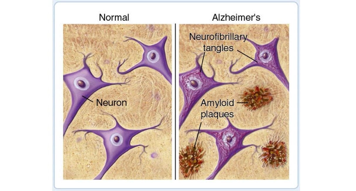 normval vs alz amyloid plaques